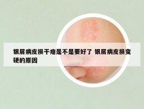 银屑病皮损干瘪是不是要好了 银屑病皮损变硬的原因