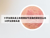 十岁女孩头皮上出现类似牛皮癣的症状怎么办 10岁女孩有头皮