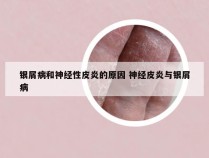 银屑病和神经性皮炎的原因 神经皮炎与银屑病