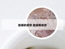 脸癣的症状 脸部癣症状