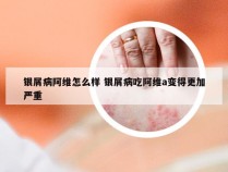 银屑病阿维怎么样 银屑病吃阿维a变得更加严重