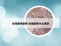 白斑藓传染吗 白斑藓有什么症状