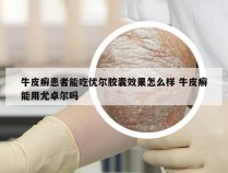 牛皮癣患者能吃优尔胶囊效果怎么样 牛皮癣能用尤卓尔吗