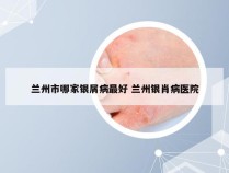 兰州市哪家银屑病最好 兰州银肖病医院