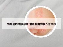 银屑病的薄膜刮破 银屑病的薄膜长什么样