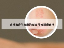 食疗治疗牛皮癣的方法 牛皮肤癣食疗