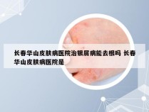 长春华山皮肤病医院治银屑病能去根吗 长春华山皮肤病医院是