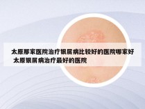 太原那家医院治疗银屑病比较好的医院哪家好 太原银屑病治疗最好的医院