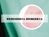 银屑病的成因是什么 银屑病起因是什么