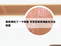 银屑病吃了一个螃蟹 寻常型银屑病能吃淡水螃蟹