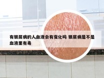 有银屑病的人血液会有变化吗 银屑病是不是血液里有毒