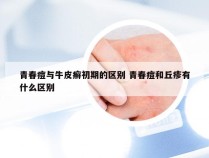 青春痘与牛皮癣初期的区别 青春痘和丘疹有什么区别