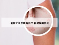 乳房上长牛皮癣治疗 乳房皮癣图片