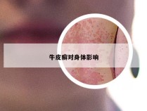 牛皮癣对身体影响
