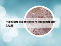 牛皮癣需要切皮肤化验吗 牛皮肤癣需要做什么检查