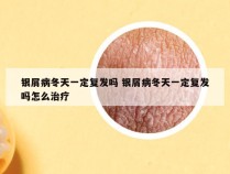 银屑病冬天一定复发吗 银屑病冬天一定复发吗怎么治疗