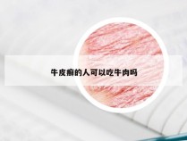 牛皮癣的人可以吃牛肉吗