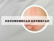 肘关节内侧长癣擦什么药 肘关节癣用什么药