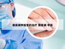 银屑病甲损害的治疗 银屑病 甲损