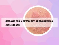 银屑病用药多久后可以怀孕 银屑病用药多久后可以怀孕呢