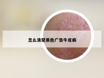 怎么清楚黑色广告牛皮癣