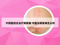 中西医结合治疗银屑病 中医治银屑病怎么样