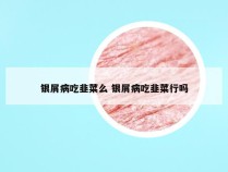 银屑病吃韭菜么 银屑病吃韭菜行吗