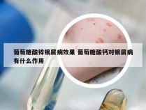 葡萄糖酸锌银屑病效果 葡萄糖酸钙对银屑病有什么作用