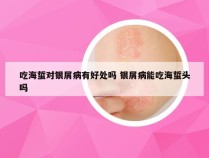 吃海蜇对银屑病有好处吗 银屑病能吃海蜇头吗