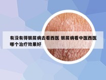 有没有得银屑病去看西医 银屑病看中医西医哪个治疗效果好