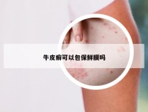 牛皮癣可以包保鲜膜吗