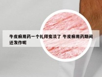 牛皮癣用药一个礼拜变淡了 牛皮癣用药期间还发作呢