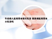 牛皮癣人能用草本御方乳膏 银屑病能用草本小乳膏吗