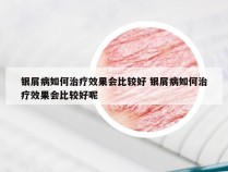 银屑病如何治疗效果会比较好 银屑病如何治疗效果会比较好呢