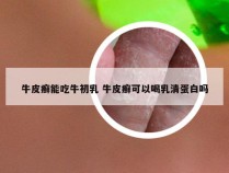 牛皮癣能吃牛初乳 牛皮癣可以喝乳清蛋白吗
