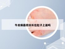 牛皮癣最初会长在肚子上面吗