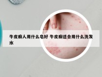 牛皮癣人用什么皂好 牛皮癣适合用什么洗发水