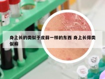 身上长的类似于皮藓一样的东西 身上长得类似癣