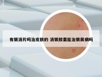 有银消片吗治皮肤的 消银胶囊能治银屑病吗