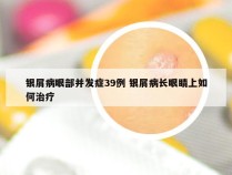 银屑病眼部并发症39例 银屑病长眼睛上如何治疗