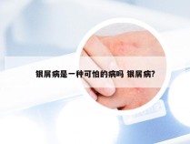 银屑病是一种可怕的病吗 银屑病?