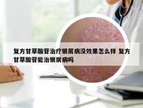 复方甘草酸苷治疗银屑病没效果怎么样 复方甘草酸苷能治银屑病吗