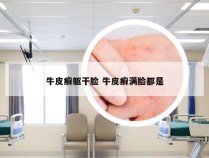 牛皮癣躯干脸 牛皮癣满脸都是