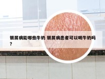 银屑病能哪些牛奶 银屑病患者可以喝牛奶吗?