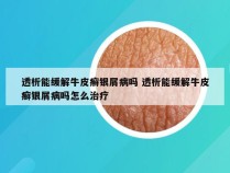 透析能缓解牛皮癣银屑病吗 透析能缓解牛皮癣银屑病吗怎么治疗