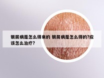银屑病是怎么得来的 银屑病是怎么得的?应该怎么治疗?