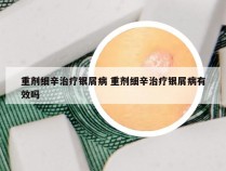 重剂细辛治疗银屑病 重剂细辛治疗银屑病有效吗