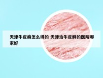 天津牛皮癣怎么得的 天津治牛皮鲜的医院哪家好