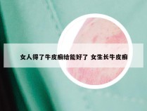 女人得了牛皮癣给能好了 女生长牛皮癣