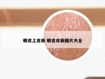 眼皮上皮癣 眼皮皮癣图片大全